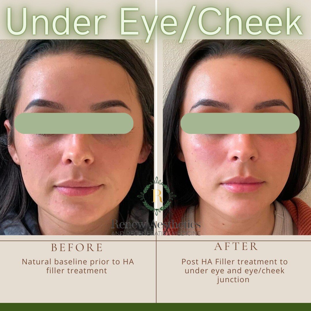 Anyone else love the beauty of a subtle refresh to under eyes and cheeks?!

Enhancing baseline bombshell beauty for a more &quot;well-rested&quot; look...😍

Get on our schedules ASAP before those summer vacays!!

253-651-9263 OR BOOK ONLINE! 
(Link 