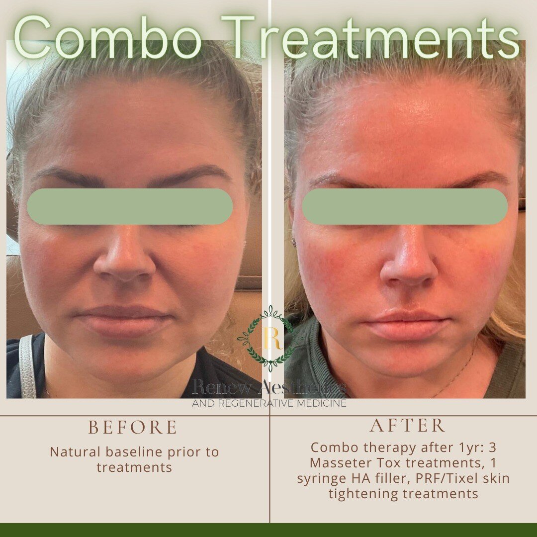 GM beauties!! Why not start the morning with a discussion on the importance of combination therapy and consistency of treatments to get to your #skingoals #beautygoals 

I often preach the importance of combo treatments because we typically have mult