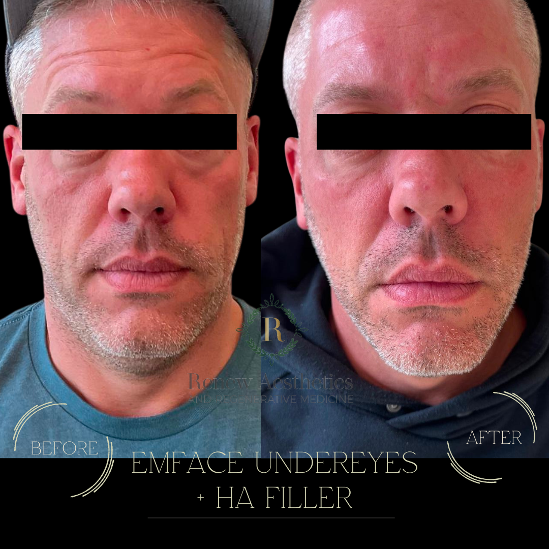Side-by-side comparison of a middle-aged man before and after cosmetic treatments, including under-eye fat transfer and hyaluronic acid filler, highlighting improvements in under-eye appearance.
