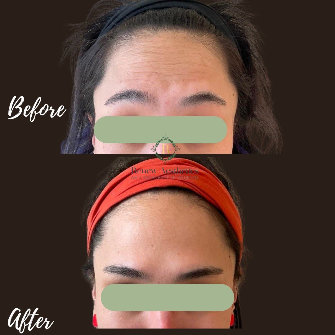 ๐Prevention is ALWAYS easier than Correction...
๐ฏ There are so many things to hesitate on...but DO NOT hesitate on starting your Tox regimen!! Whether we're PREVENTING the presentation of deep wrinkles or we're IMPROVING the appearance of existing