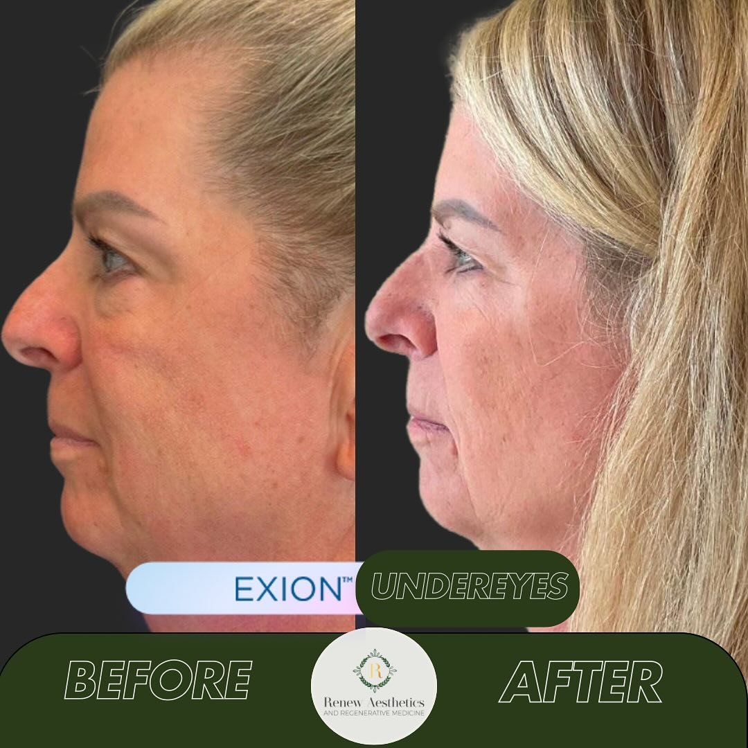Obsessed with this beautiful and natural-looking undereye refresh with @exionusa #exionface treatments!!
Interested in a natural approach to building your body’s Hyaluronic Acid by 224%…call and book a consultation with us because we&rs
