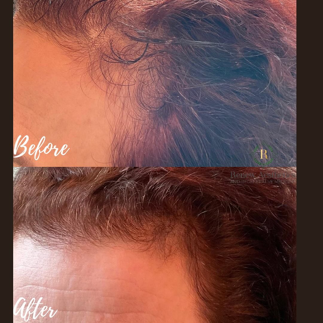 ๐ฟStruggling with thinning hair OR recovering from a hair transplant? Let’s talk about PRP/PRF Hair Restoration!
๐ฉธPRP (Platelet-Rich Plasma) and PRF (Platelet-Rich Fibrin) are powerful, natural treatments that use your own blood’s growt