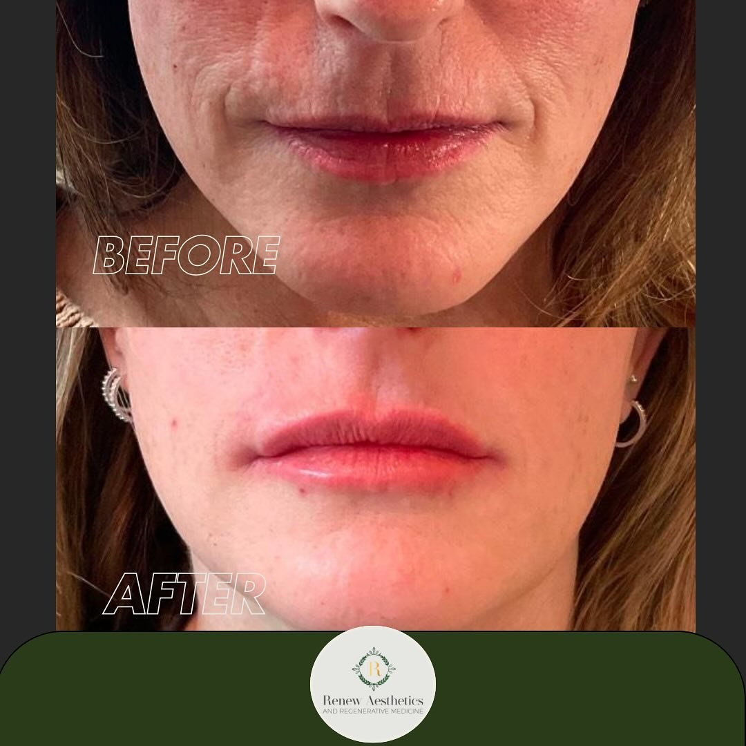 ๐ฃLip filler isn’t just about plump lips ๐— it’s also a powerful tool for softening vertical upper lip lines that can subtly age the lower face. With a skilled approach, lip filler can:
• Restore hydration and volume
• S