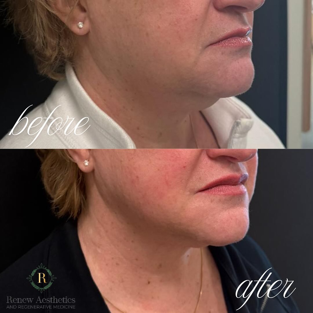 ๐We’re OBSESSED… and not even trying to hide it.
๐ฅEmFace is our go-to for combo therapy to tighten and tone the lower face, snatching the jawline, and saying ๐๐ผBYE to that difficult-to-treat double chin — BONUS: EmFace is all