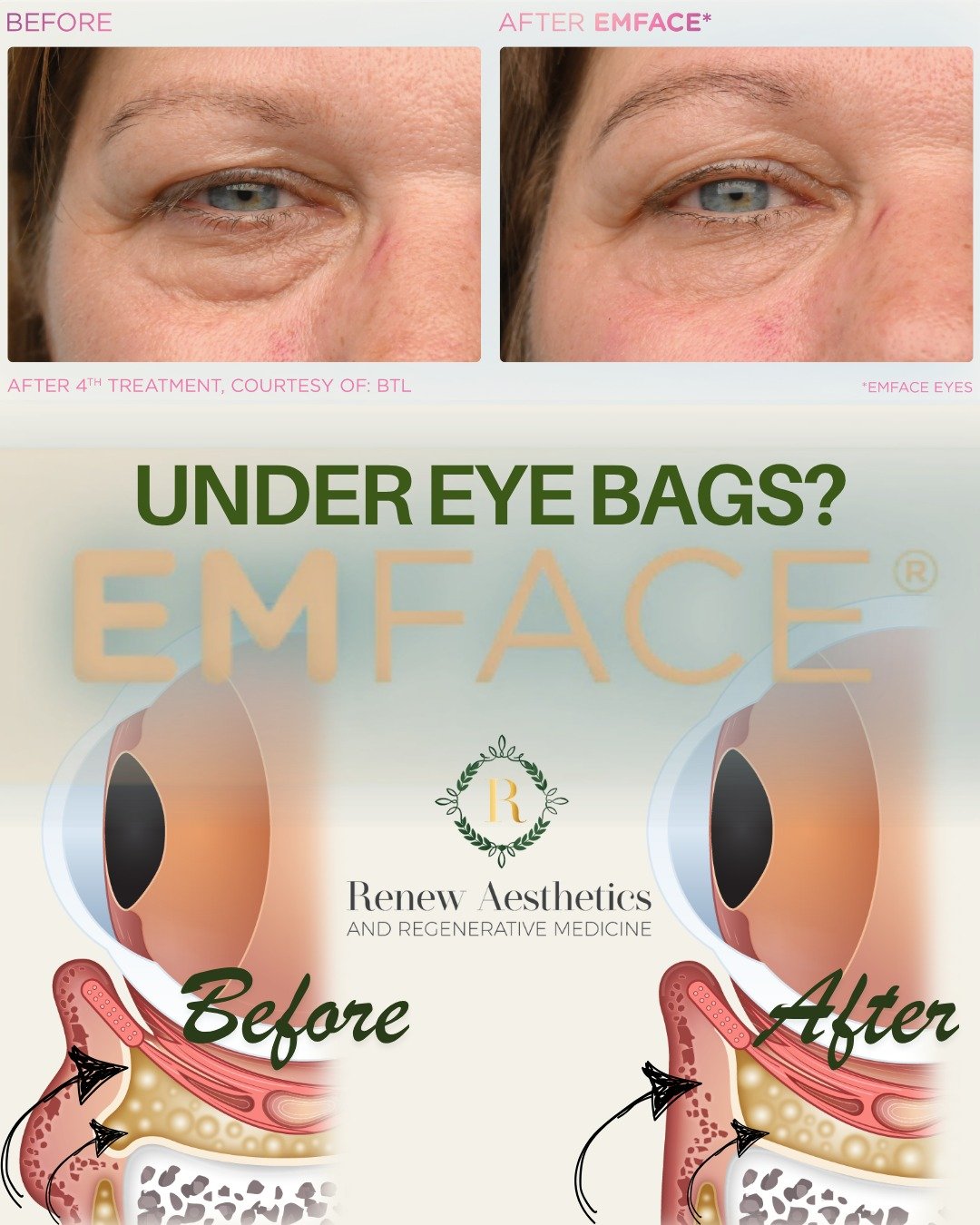 π Wondering how EmFace helps reduce under-eye bags? Let’s talk!
As we age, the circular muscle that supports the under-eye area naturally loses tone and tension. When this muscle weakens, it can no longer hold back the infraorbital fat pads (