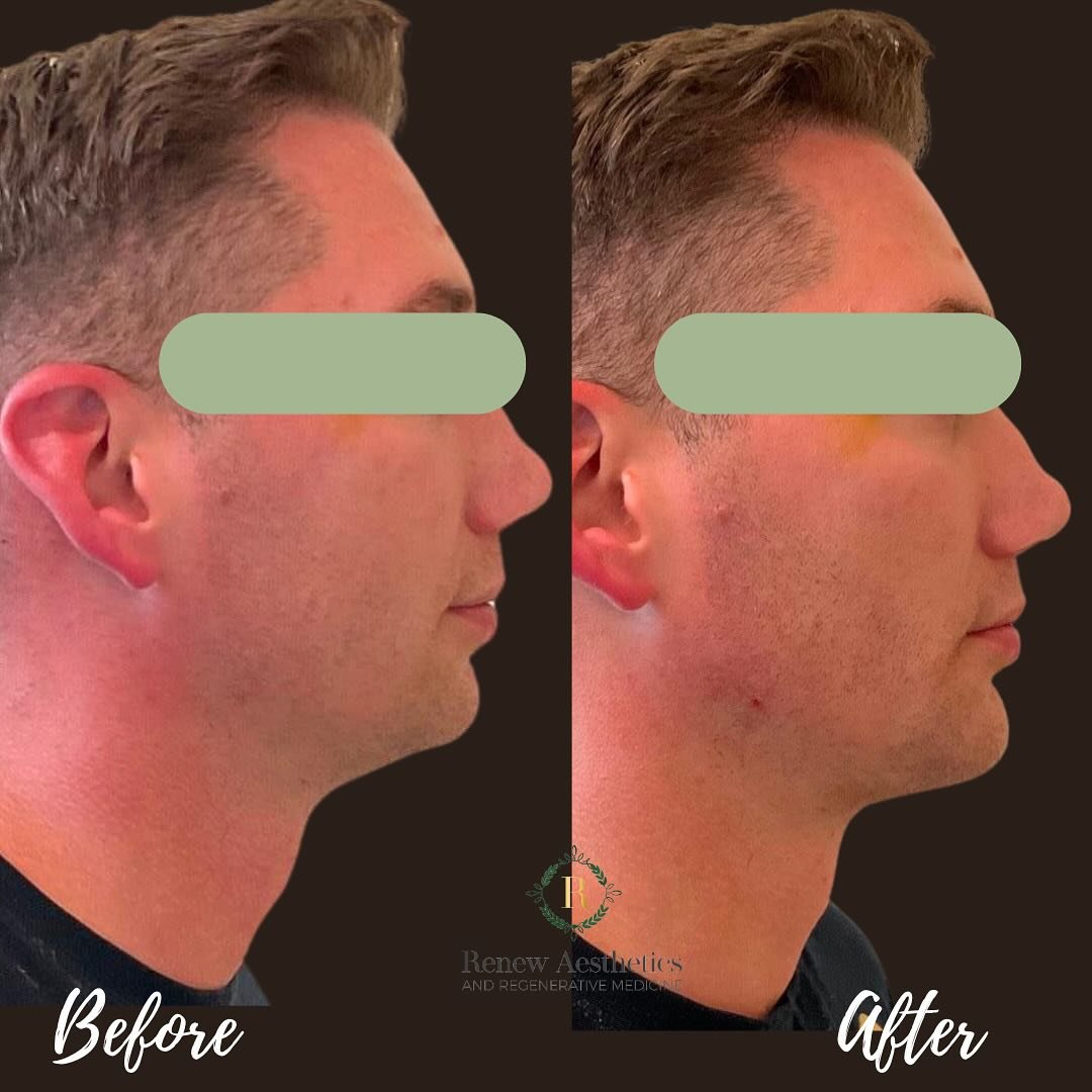 π£ Spotlight Treatment Alert! π¦
My most stubborn patient? My husband. ππ
But when the results speak for themselves…his only response was “of course I only let the best touch my face” π€£π (forever the hype man)
•
•
&bu