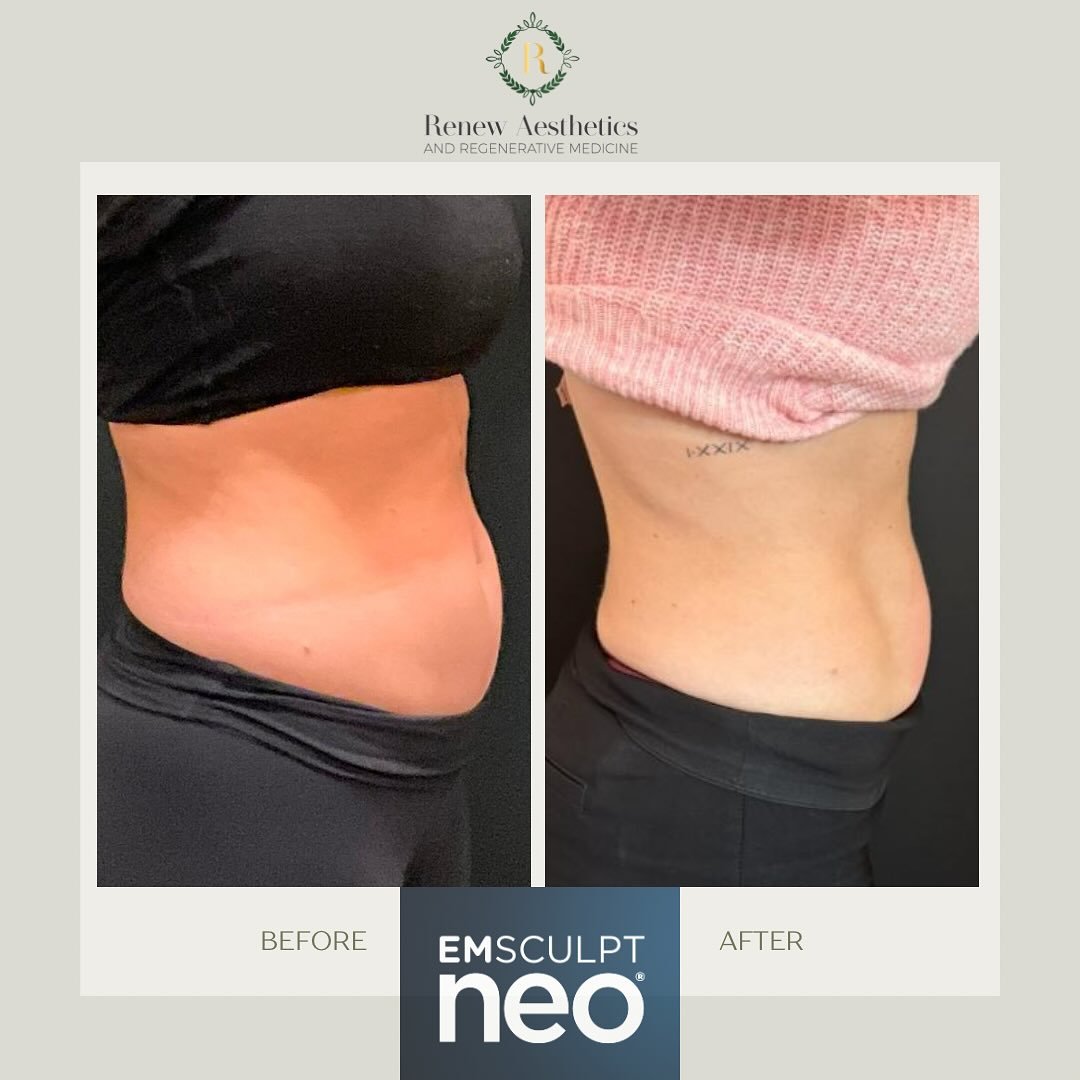 π₯ Not Just for Looks: EmSculpt NEO Builds a Stronger Core from the Inside Out π₯
Looking for more than a flat stomach?
EmSculpt NEO does more than sculpt—it strengthens.
By combining high-intensity focused electromagnetic (HIFEM+) energy wit