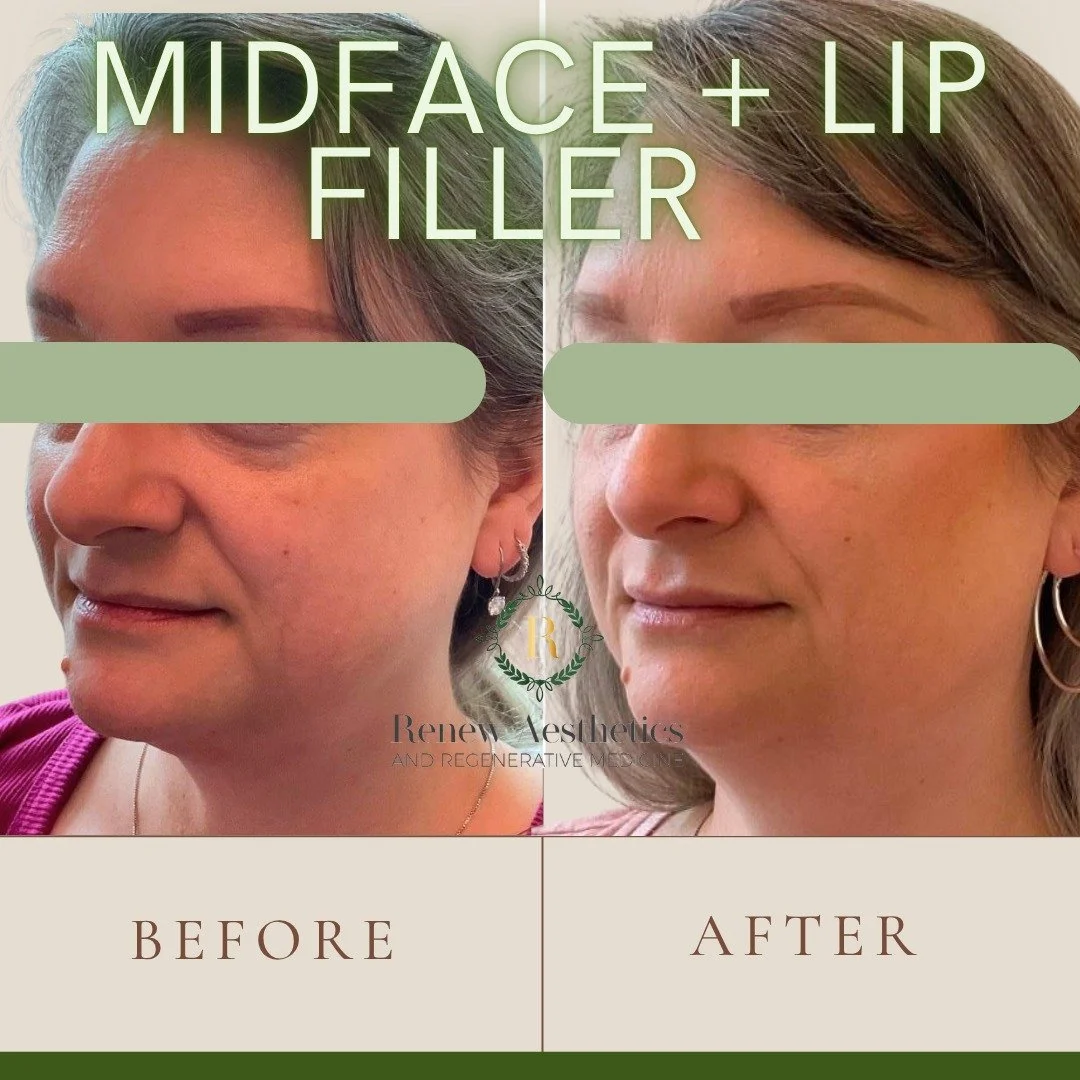 ✨ The Art of Effortless Beauty! ✨
When filler is placed naturally in the mid & lower face, the results are all about balance — not bulk. Think:
💖 Softer smile lines
💖 Lifted cheeks = less jowling, less folds around the mouth
💖 Smooth ja