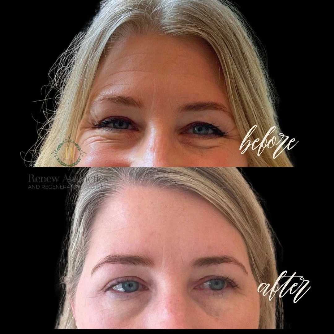 ✨💉 Let this be your sign: “do the tox” 💉✨
Sometimes all you need is a subtle refresh (you already have that GORGEOUS baseline!)—smooth those fine lines, lift your look, and bring back that effortlessly youthful vibe.
Think of it