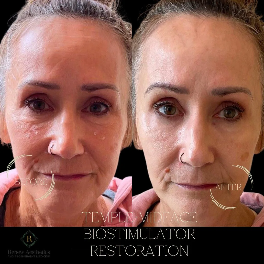 ✨ Facial Balancing — The Art of Refreshingly Ageless✨
When it comes to restoring youthfulness, balance is everything. Treatments that focus on the temples and midface create structure, softness, and natural harmony — not an overfilled lo