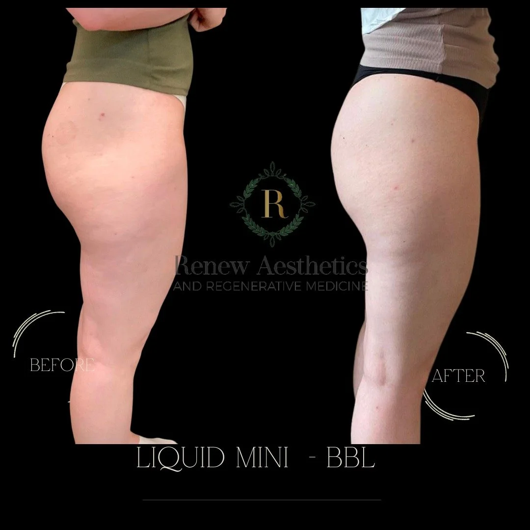 🍑✨ It’s officially peach-building season. ✨🍑
Looking for shape, volume, and a smoother silhouette — without surgery? Our Liquid Mini-BBL is your go-to for subtle, natural-looking enhancement.
💉 How it works:
This non-surgical treatme