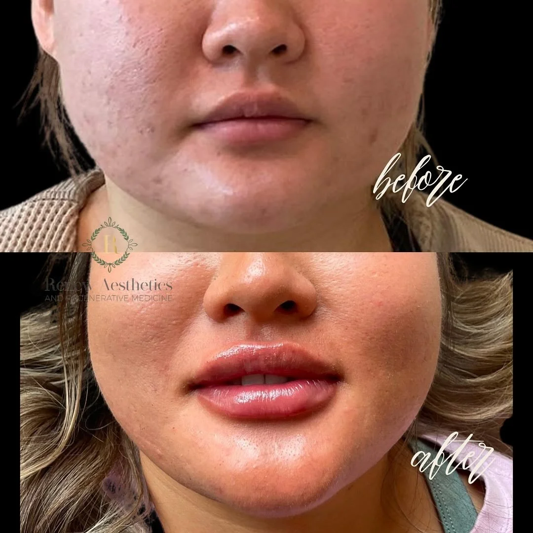 Obsessed with these lippies that scream KISS ME 💕🪩👄

&bull;
Single syringe lip filler @restylaneusa - LIMITED APPTS AVAILABLE! Book your consultation before those holiday photos and events!!!

#renewpnw #lipfillers #lipfillerbeforeandafter #juicyl