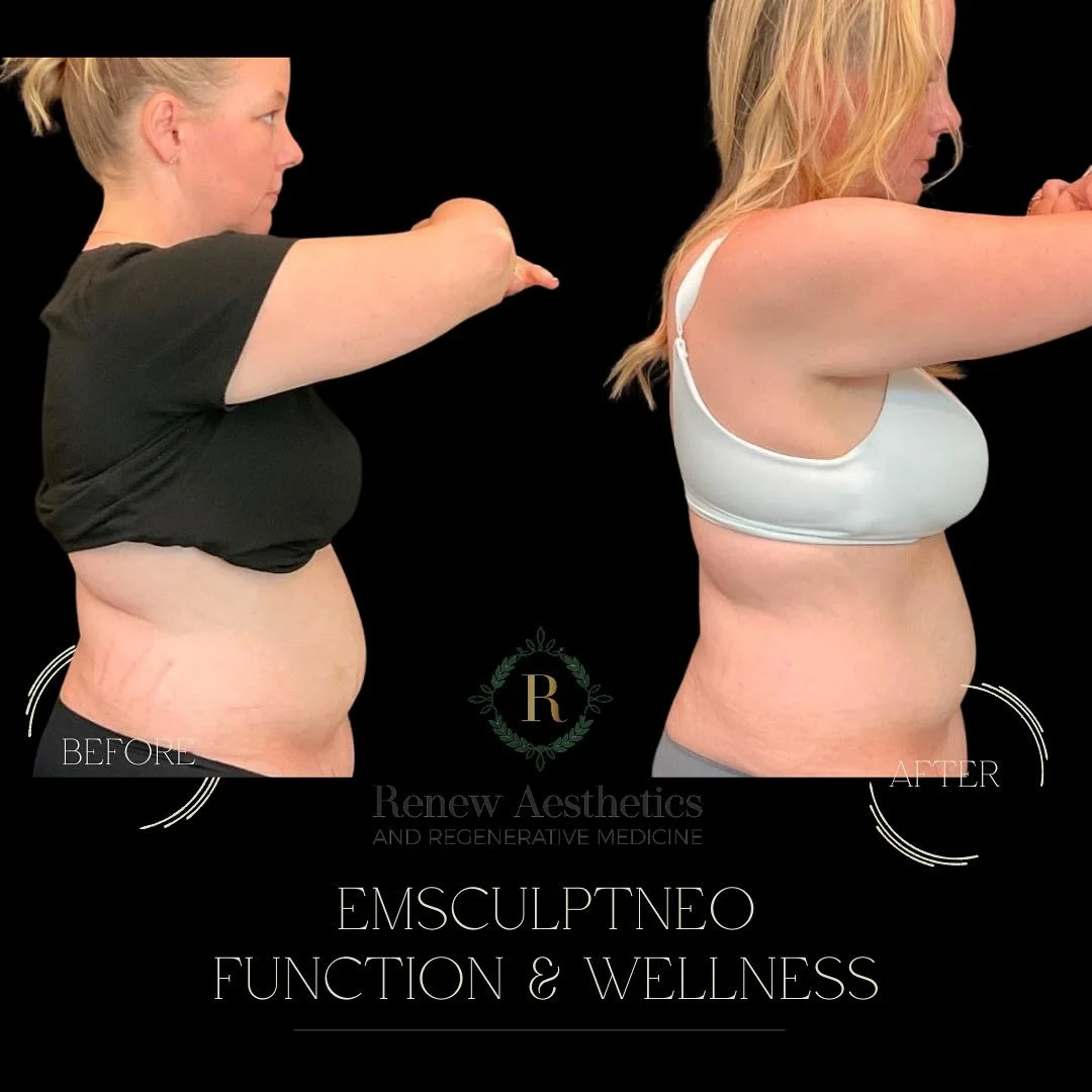 ✨ EmSculpt NEO: Function &bull; Form &bull; Wellness ✨

At Renew Aesthetics, EmSculpt NEO isn&rsquo;t just about looking toned&mdash;it&rsquo;s about moving, supporting, and performing better.

💪 What It Does
&bull; Builds functional muscle + burns 