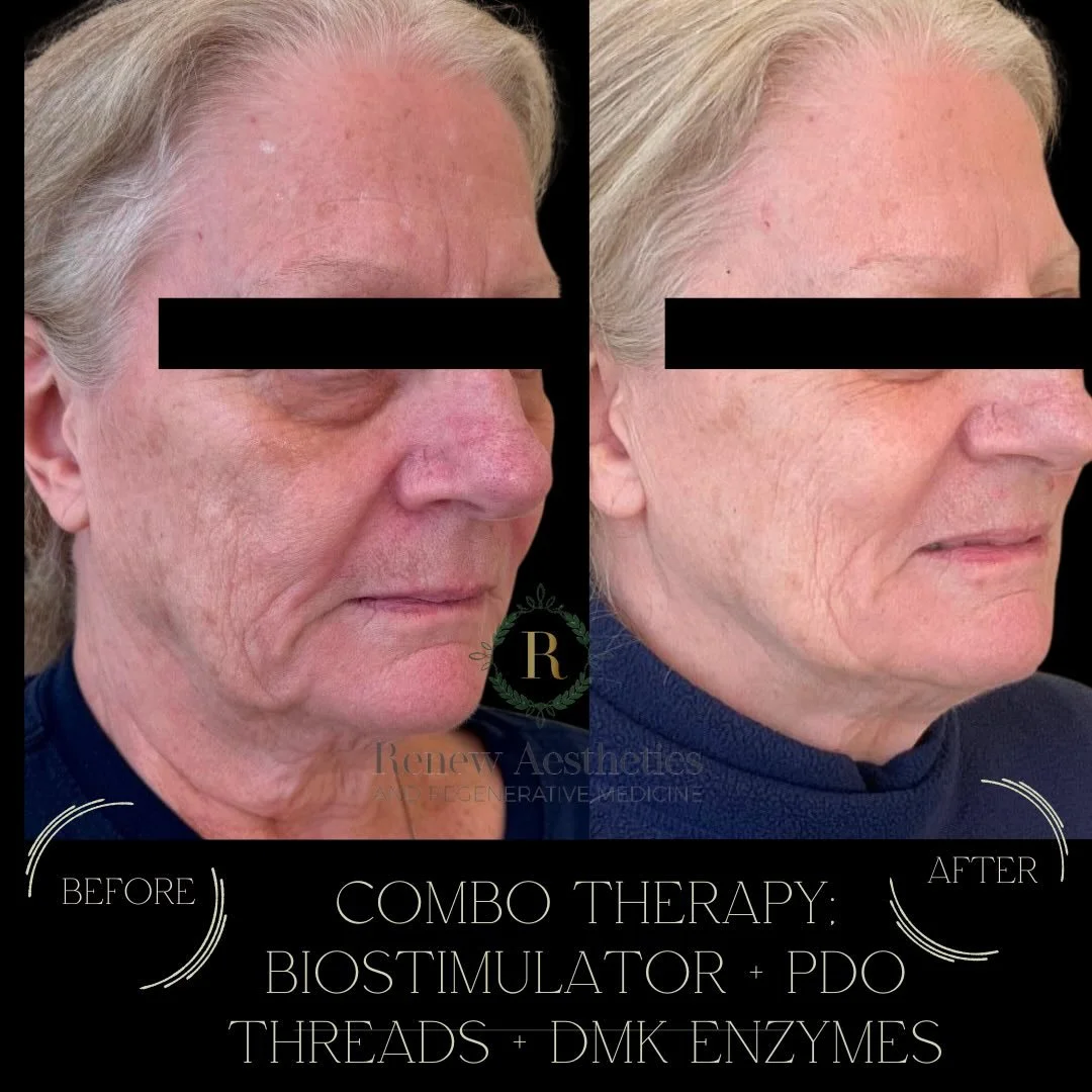 🧠 Aging is layered&hellip; and your treatment plan should be too.

By combining biostimulators, PDO threads, and DMK enzyme therapy, we&rsquo;re not just treating the face &mdash; we&rsquo;re restoring the system that creates radiant, youthful skin.
