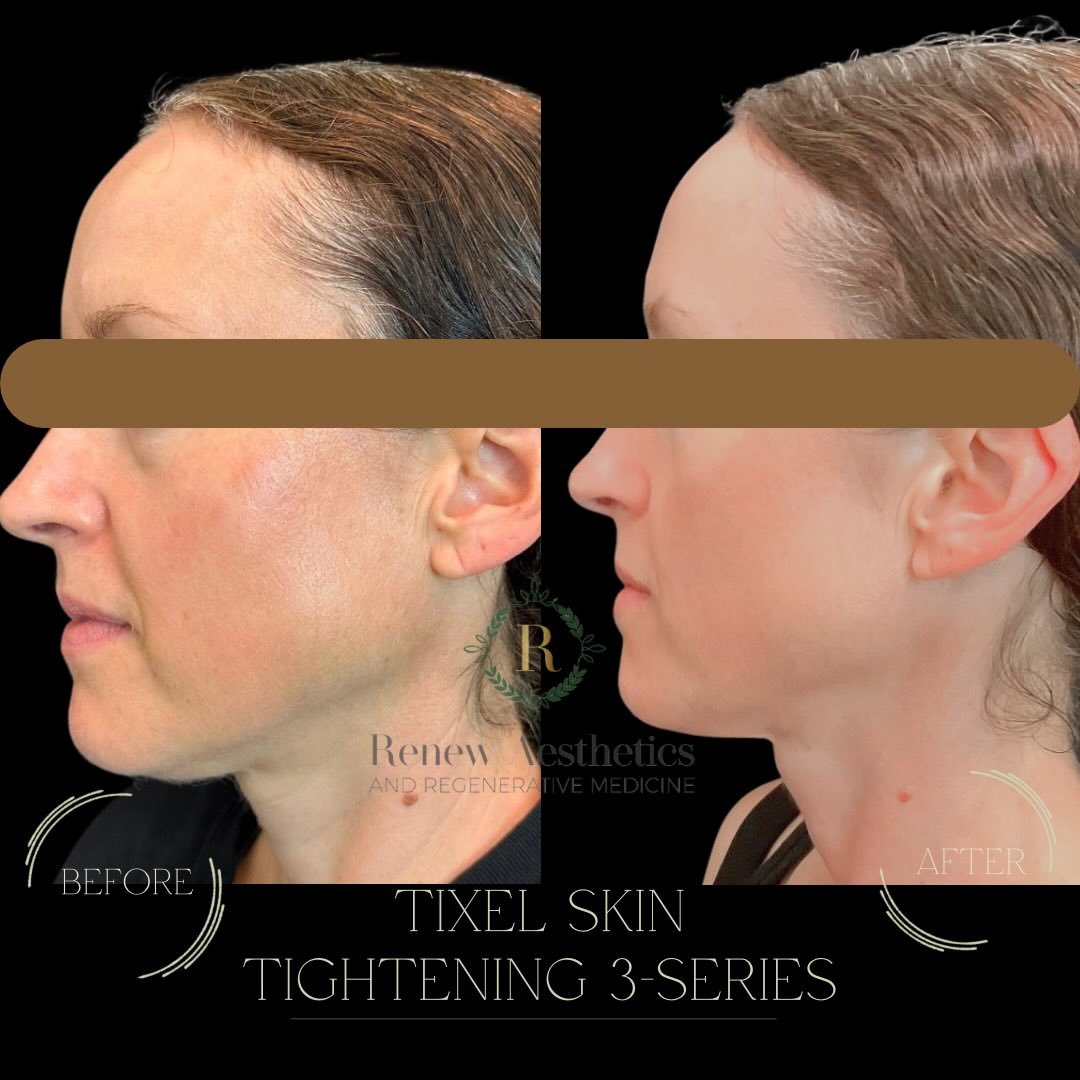 ✨ Tixel Skin Tightening: Real Results, No Needles ✨

This before &amp; after highlights the power of a Tixel treatment series&mdash;a cutting-edge, non-laser technology designed to tighten, smooth, and rejuvenate the skin with minimal downtime.

What