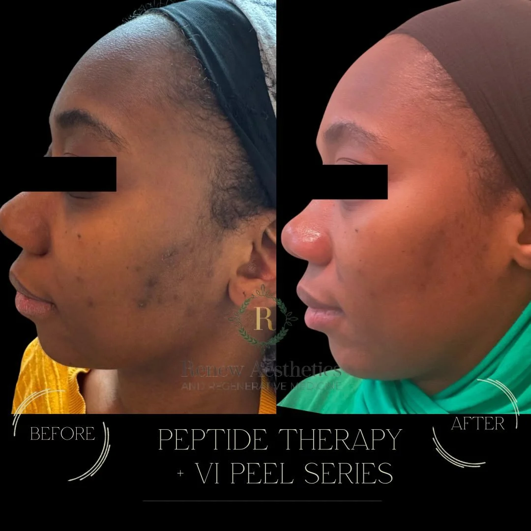 ✨ Bright Skin Isn&rsquo;t an Accident. It&rsquo;s a Strategy. ✨

Our advanced Renew brightening protocol combines targeted GHK-Cu copper peptides+vitamin + antioxidants blends, a mid-depth VI Chemical Peel series, and DMK Alkaline Wash therapy to cor