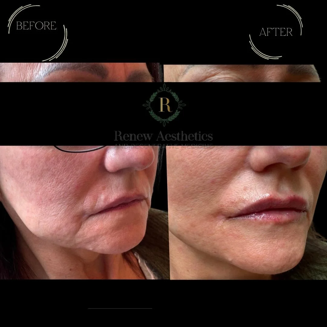 🌿The lower face plays a meaningful role in overall facial support &mdash; 

🌿Over time, changes in bone, facial muscles, and collagen/tissue can affect the jawline, lips/perioral region, and chin; subtly altering the contour and support in these ar