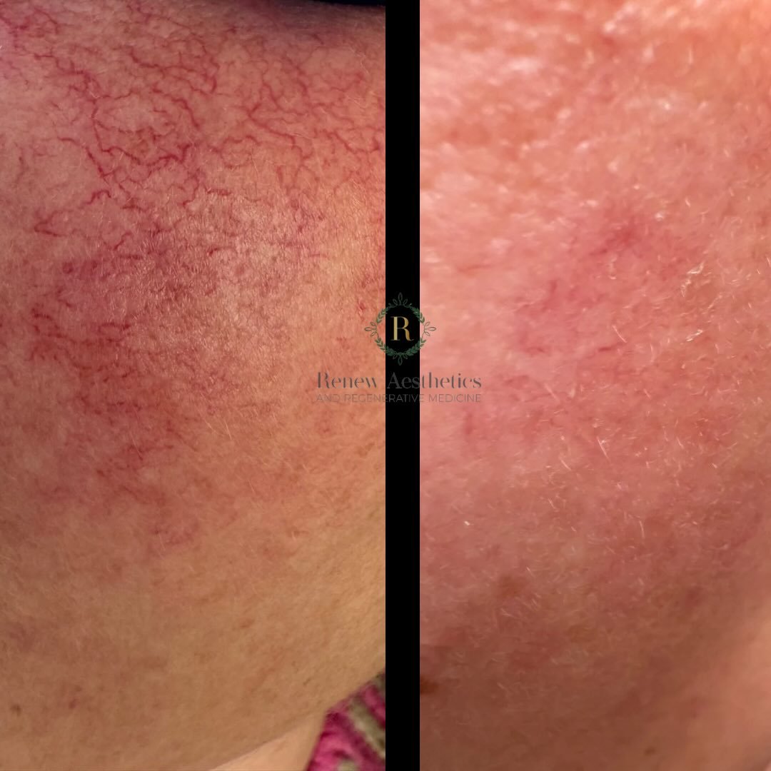 POV: I went to the gym fresh-faced for the first time in a LONG time.

Red vessel laser treatments target unwanted capillaries and facial redness &mdash; helping restore a more even, calm complexion over time.

For many clients, it&rsquo;s not about 