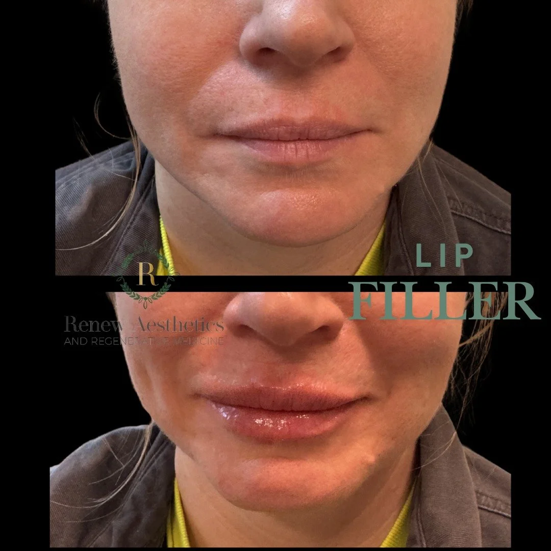 💋 February Forecast: 100% Chance of Fresh Lips 💋

Cold air = dry lips
Dry lips = not the vibe

Swipe to see this February lip glow-up ➡️

Subtle volume.
Hydrated, healthy lip structure.
Still YOU &mdash; just refreshed, balanced, and photo-ready.

