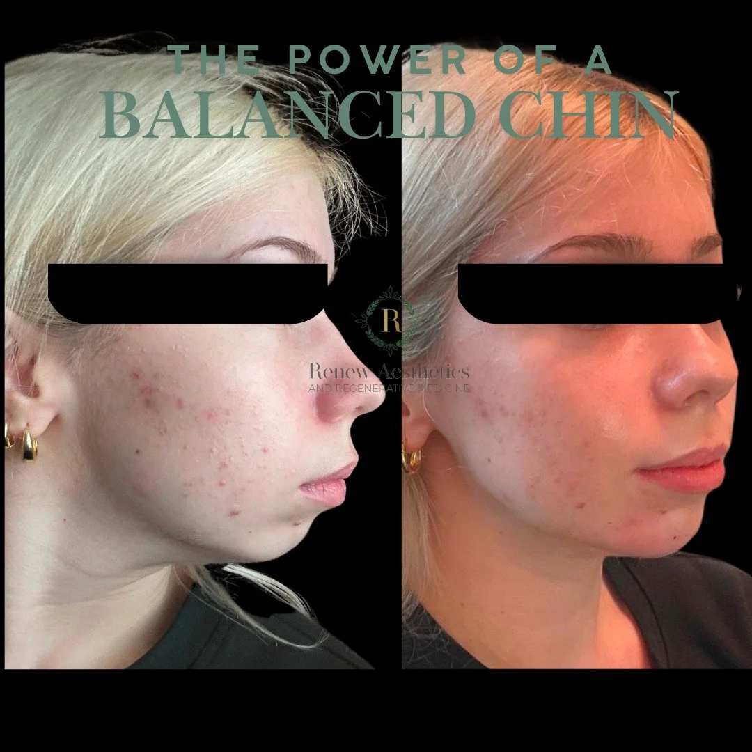 The chin is one of the most powerful &mdash; and most overlooked &mdash; features in facial harmony.

A balanced chin doesn&rsquo;t just change your profile.
It can transform how the entire lower face looks.

🧠 Why Chin Balance Matters 
As we age &m