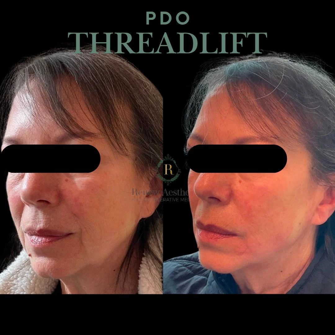 PDO threadlifting is designed to reposition and support tissue in areas where we naturally lose structure over time&mdash;especially through the mid to lower face, jowls, and perioral region.

What you&rsquo;re seeing here:
&bull; Immediate soft lift