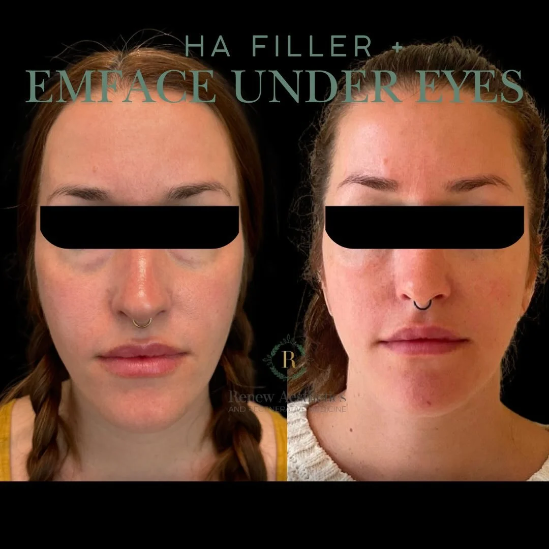 The under-eye is one of the most delicate&mdash;and most misunderstood&mdash;areas to treat.

True rejuvenation here isn&rsquo;t about simply &ldquo;filling.&rdquo;
It&rsquo;s about addressing both structure and support.

This result was achieved usi