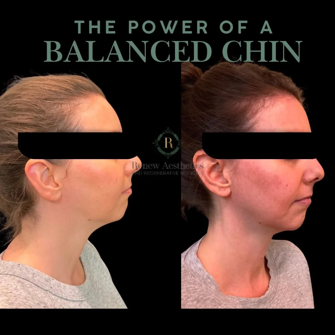The smallest adjustments often create the most powerful shifts.

A balanced chin isn&rsquo;t about making something bigger&mdash;it&rsquo;s about creating harmony across the entire profile.

When the chin is properly supported, you&rsquo;ll notice:
▫