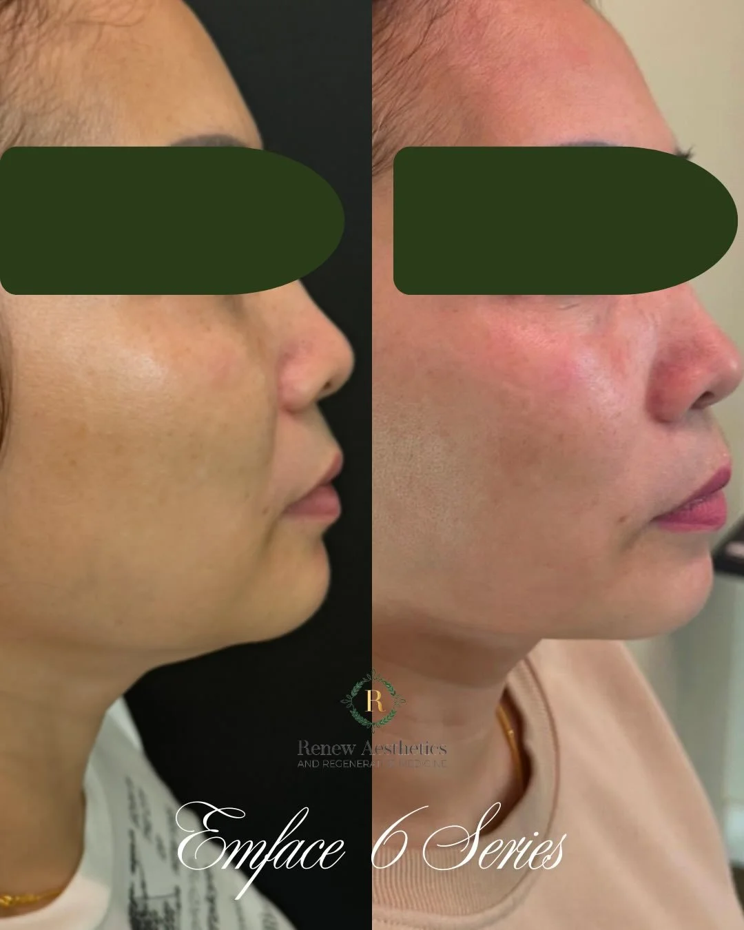 POV: you didn&rsquo;t add volume&hellip; you rebuilt support.

This is what happens when we treat the structure, not just the surface.

EMFACE | 6 Treatment Series
A non-invasive approach to lifting and tightening that works with your anatomy&mdash;s