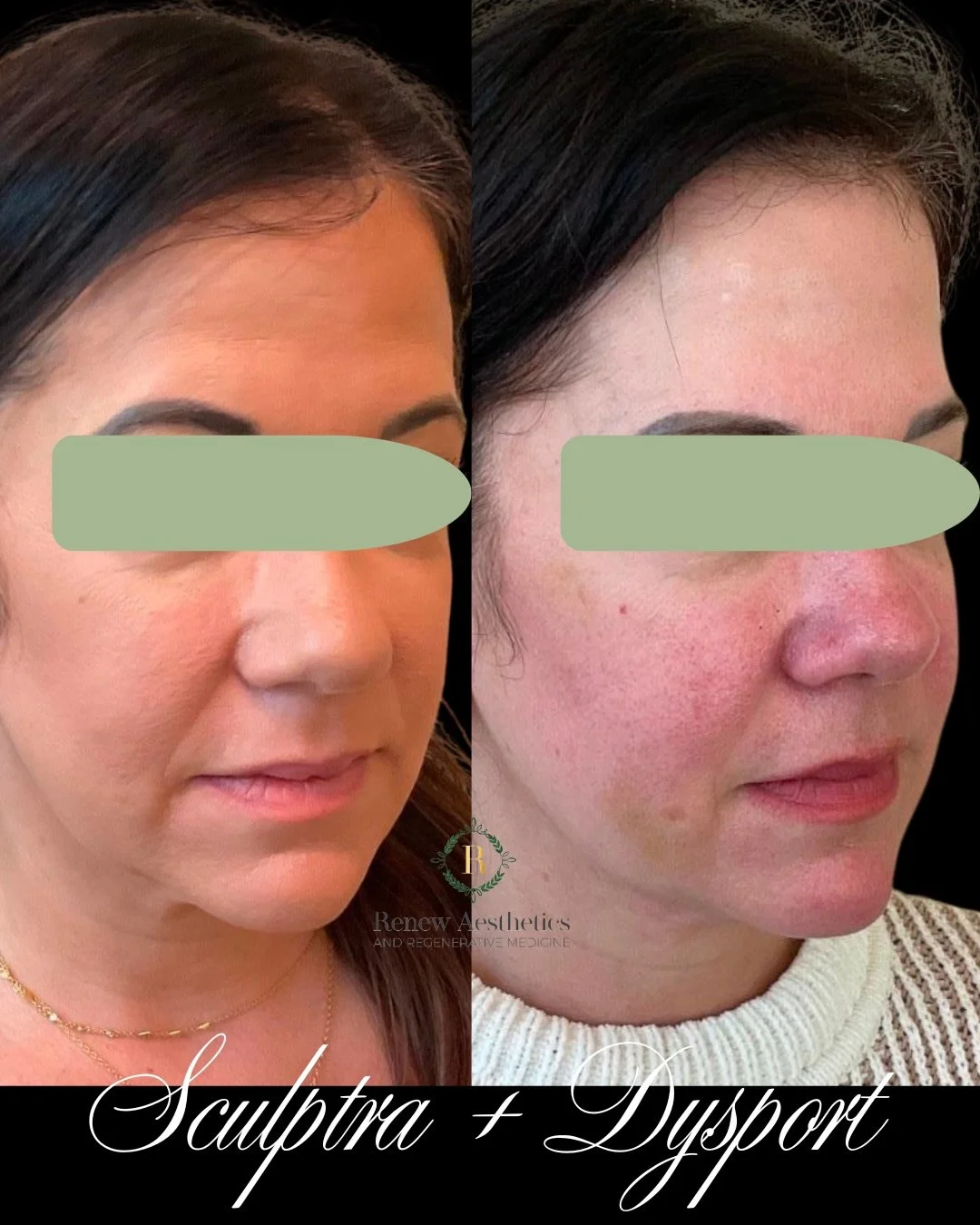 Subtle shift. Structural renewal. ✨

This is what happens when we strategically treat the foundation&mdash;
✨ Sculptra to restore collagen over time
✨ Dysport to soften and refine movement

The result? Skin that looks stronger, smoother, and quietly 
