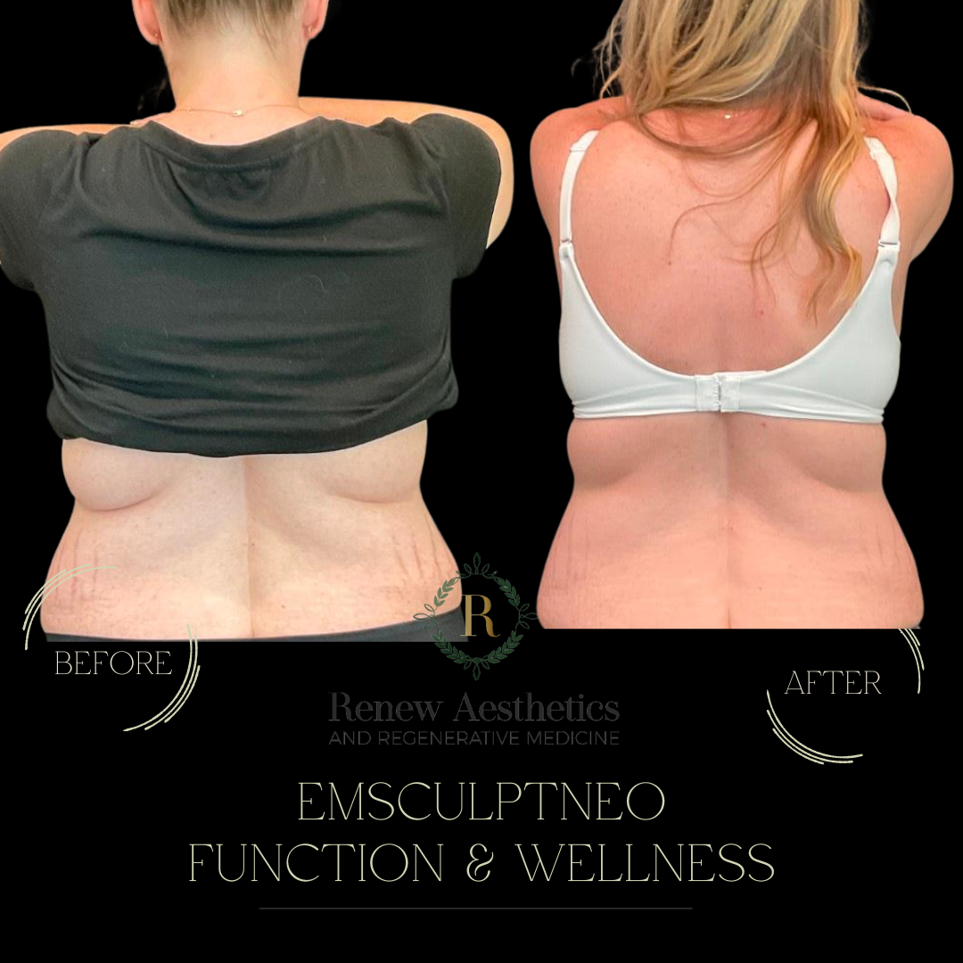 emsculptneo body fat loss 