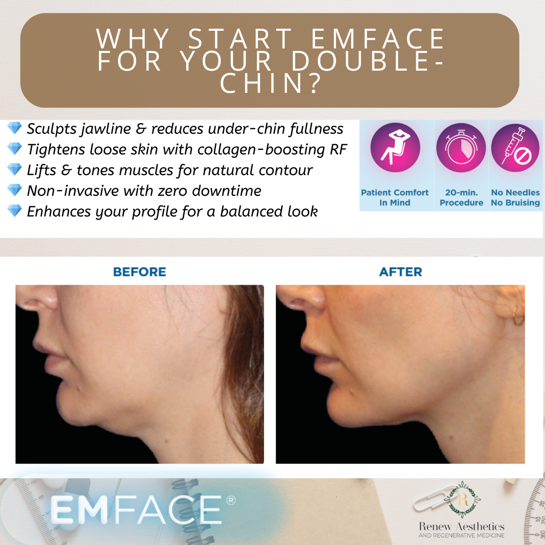 Comparison before and after photos showing a woman's profile, highlighting the results of an EMFACE treatment for jawline and chin contouring.