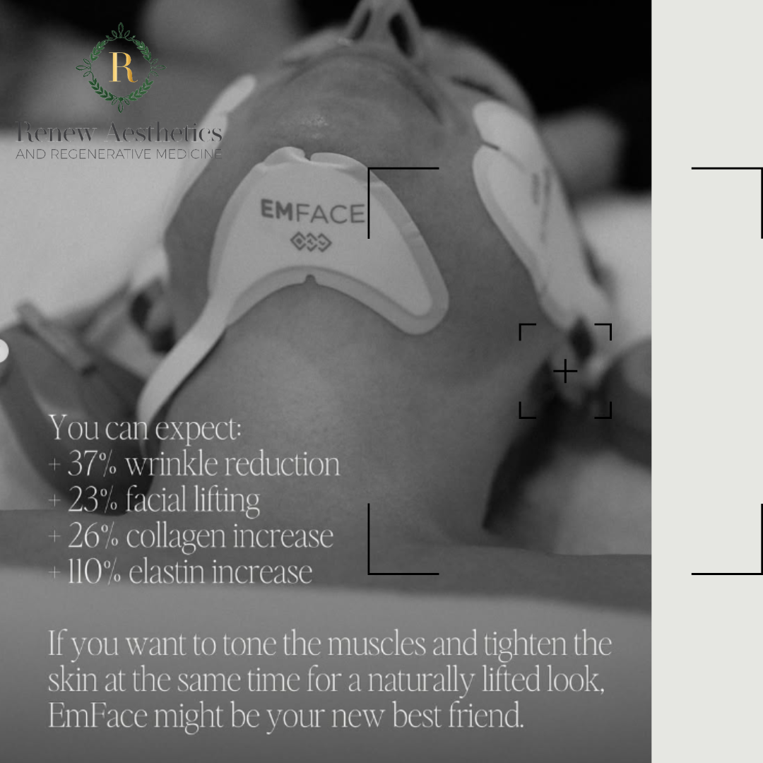 emface nonsurgical facelift collagen wrinkle reduction