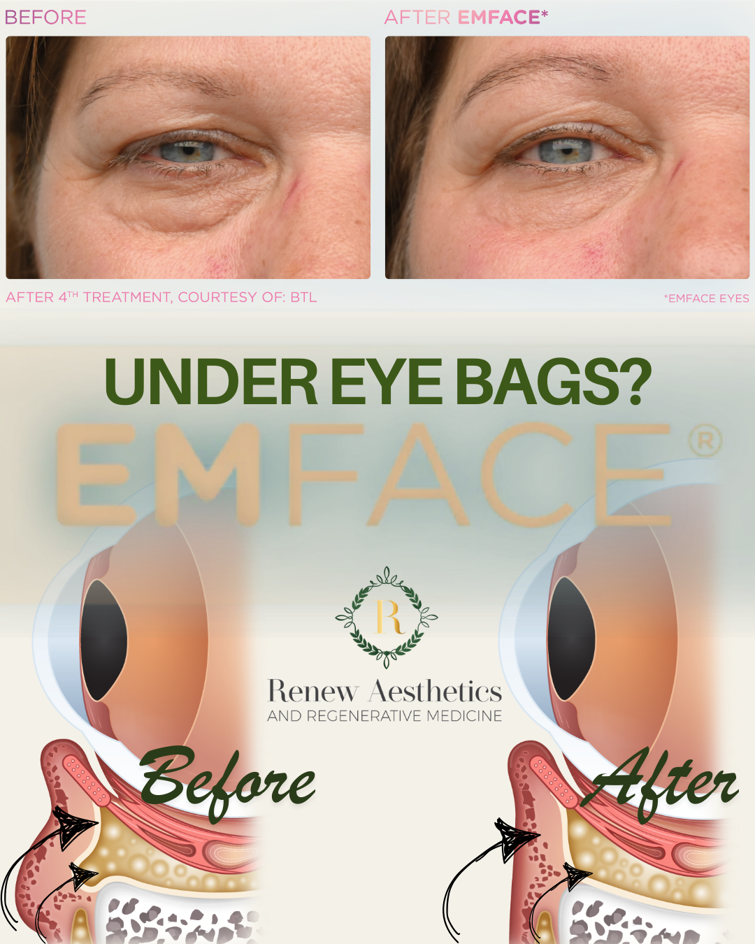 A comparison of before and after images showing a woman's eye with under-eye bags, with detailed medical diagrams illustrating the treatment process for under-eye puffiness by Renew Aesthetics.