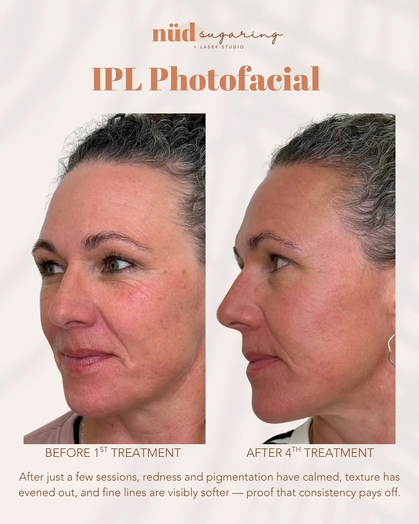 𝗜𝗣𝗟 𝗣𝗵𝗼𝘁𝗼𝗳𝗮𝗰𝗶𝗮𝗹𝘀⚡️

We are SO excited to share these before and after photos of our beautiful clients IPL Photofacial results! This is after just 4 treatments.

You can see that her redness and pigmentation have calmed down significant