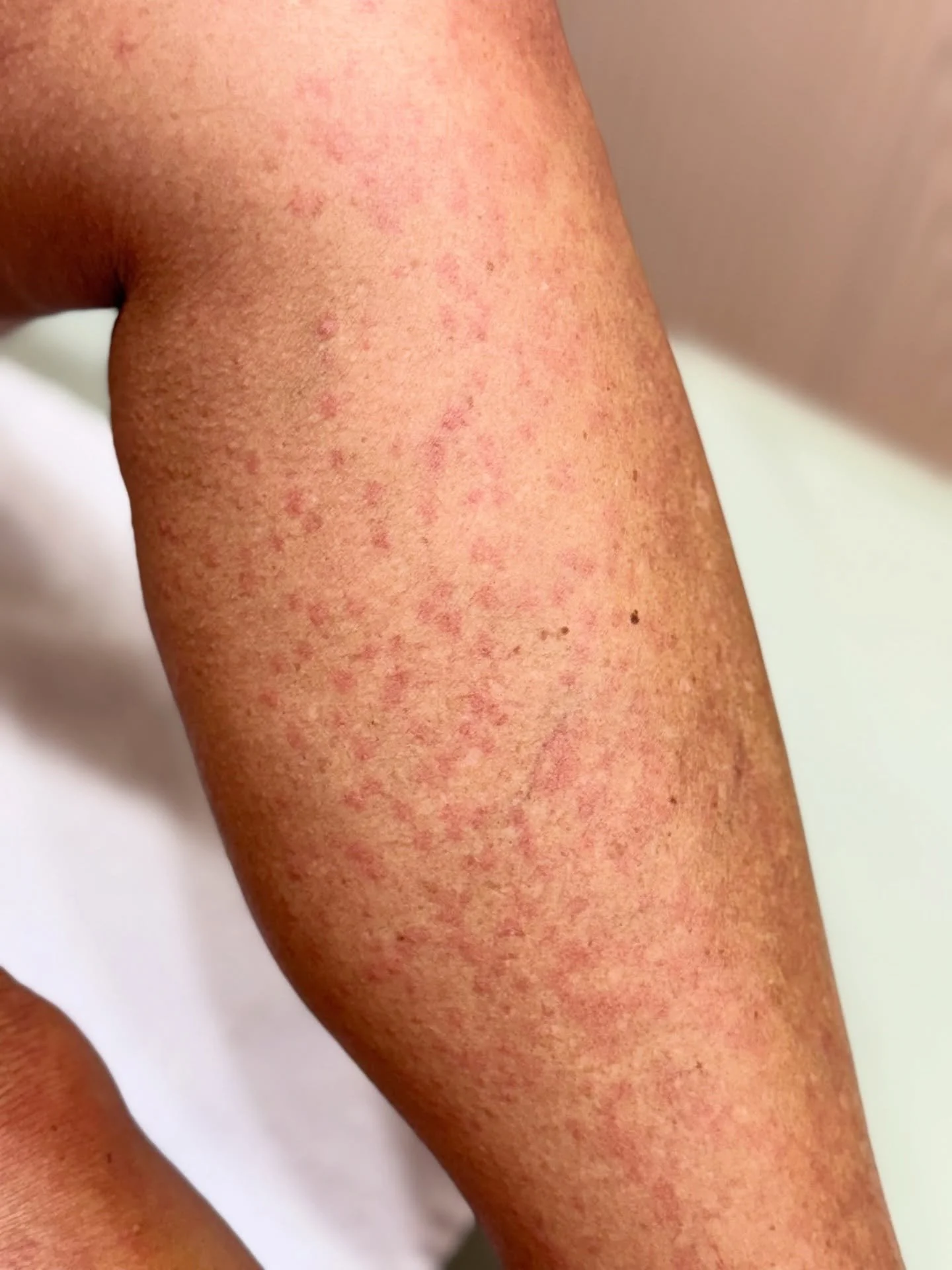 𝗟𝗘𝗧𝗦 𝗧𝗔𝗟𝗞 𝗛𝗜𝗦𝗧𝗔𝗠𝗜𝗡𝗘 𝗥𝗘𝗔𝗖𝗧𝗜𝗢𝗡𝗦

If you ever notice tiny red bumps that look a bit like a rash or hives right after your sugaring appointment, that&rsquo;s what we call a histamine reaction. And the good news: It&rsquo;s total