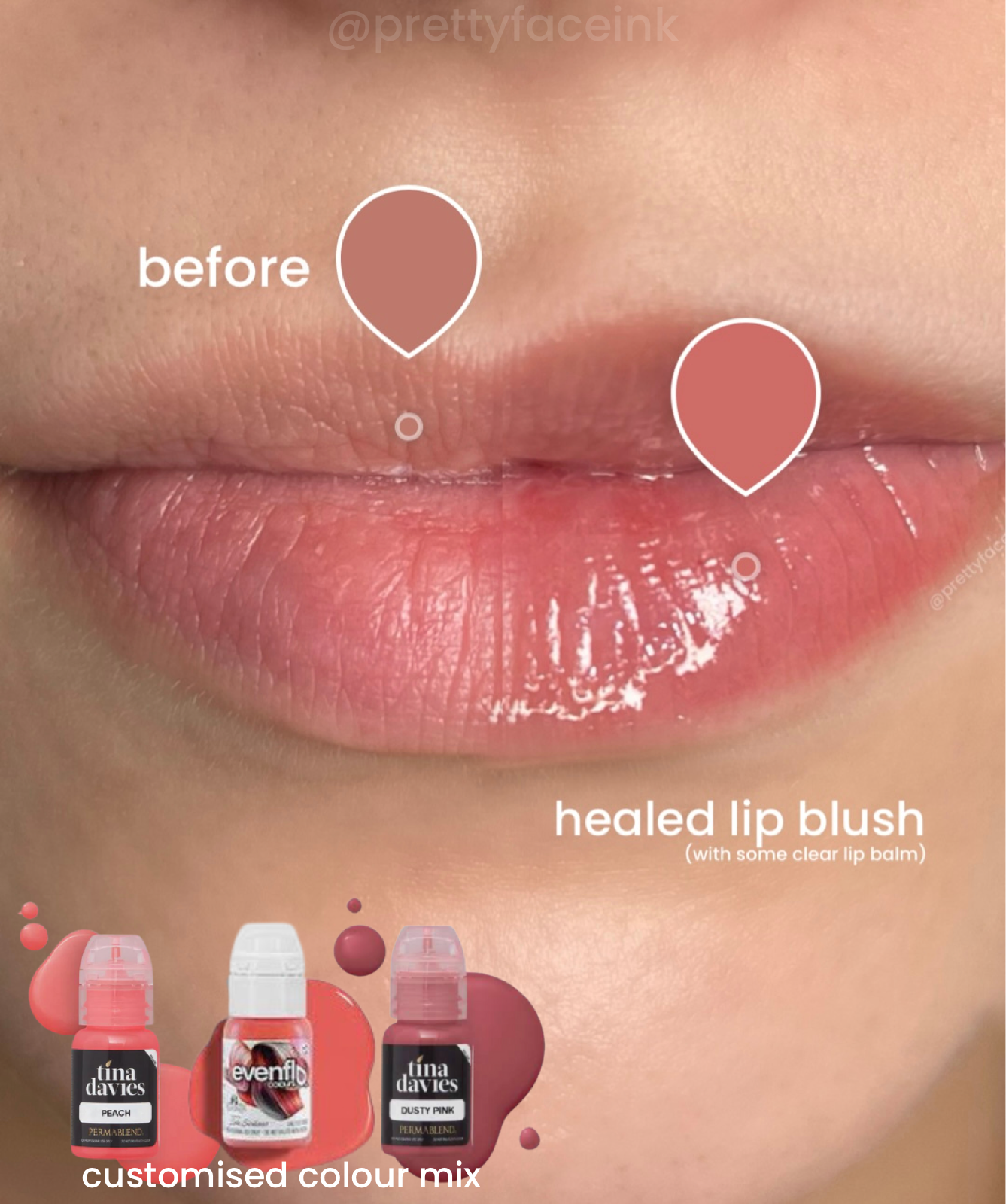 healed lip blush adelaide lip filler.PNG