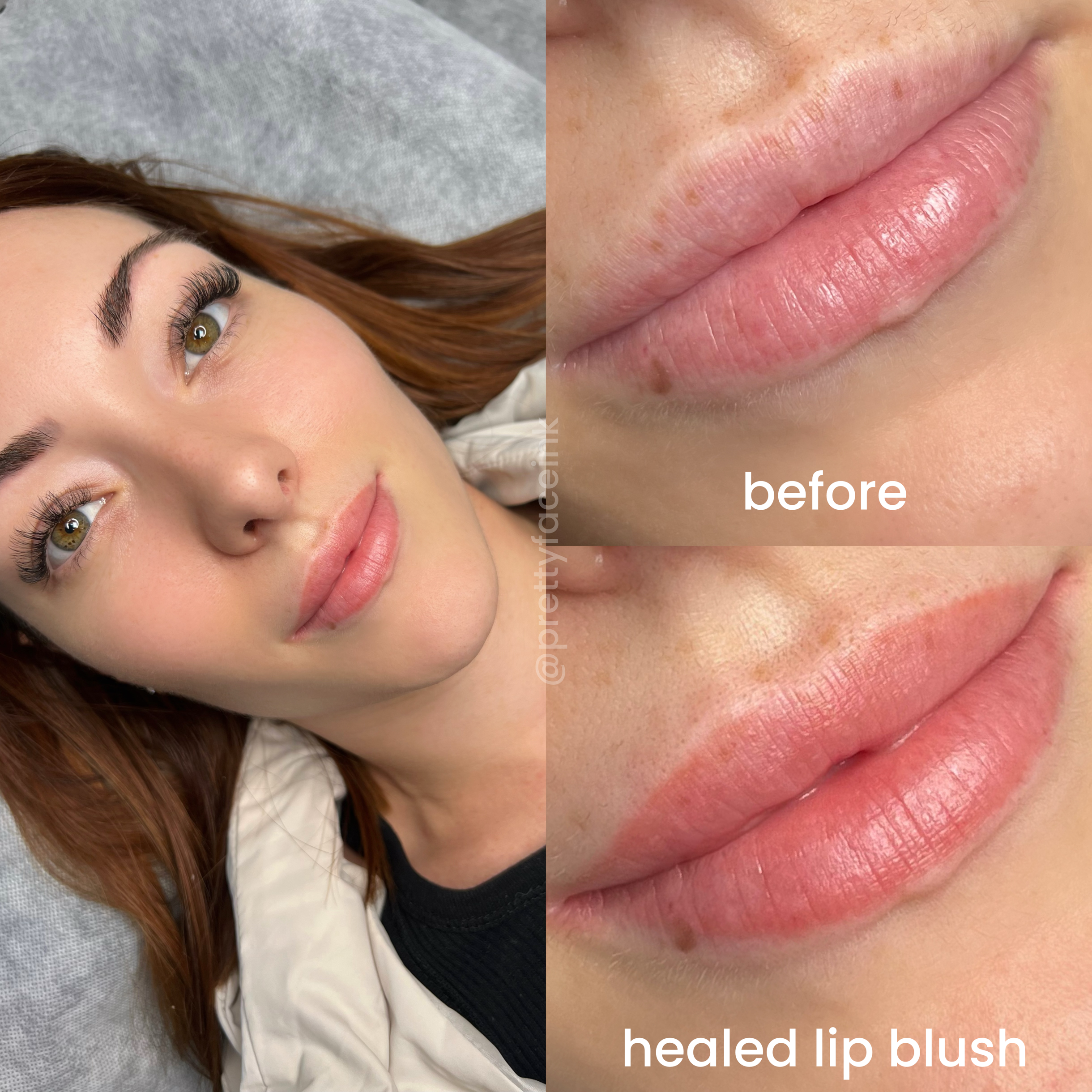 natural healed result.PNG