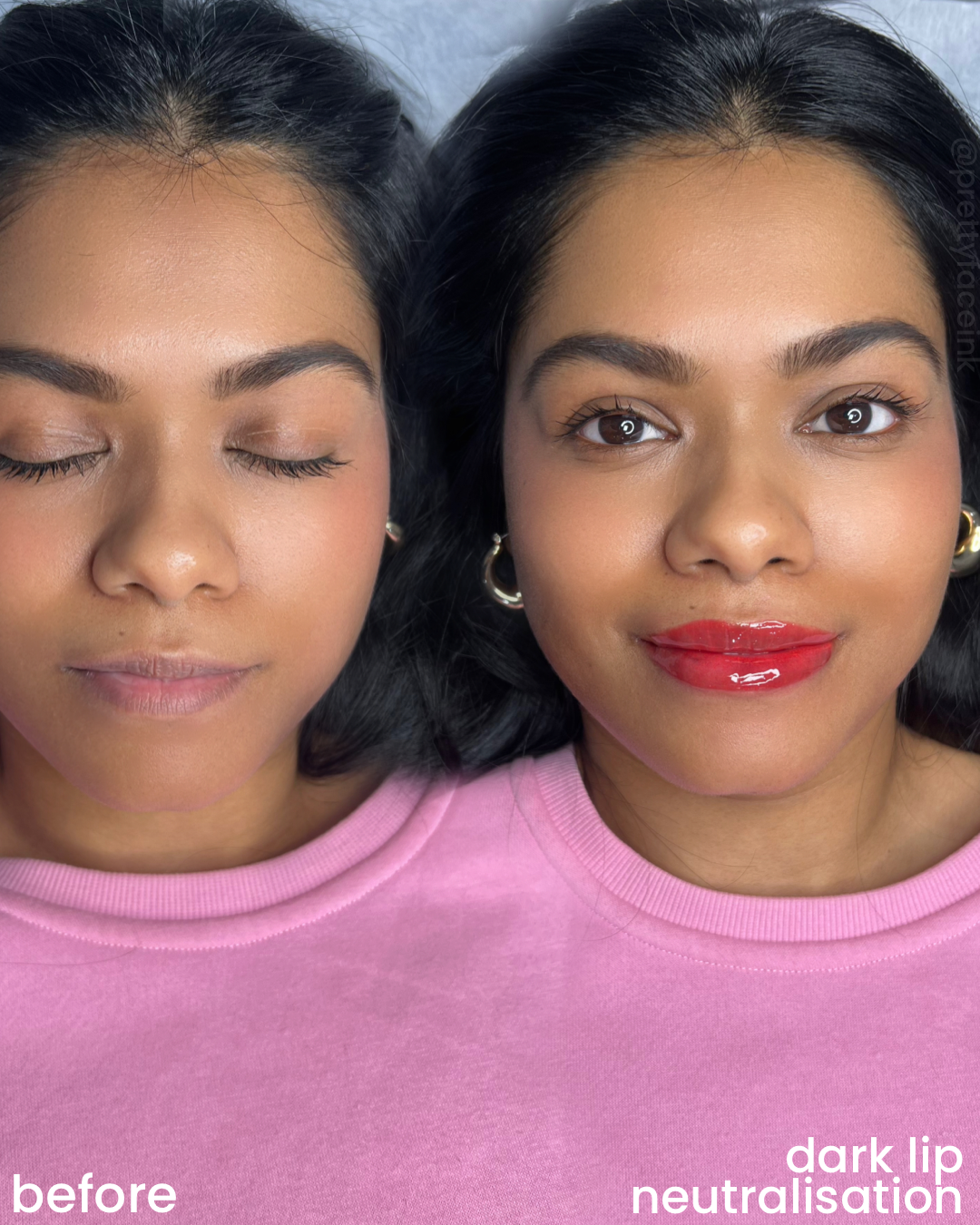 dark lip neutralisation adelaide.PNG