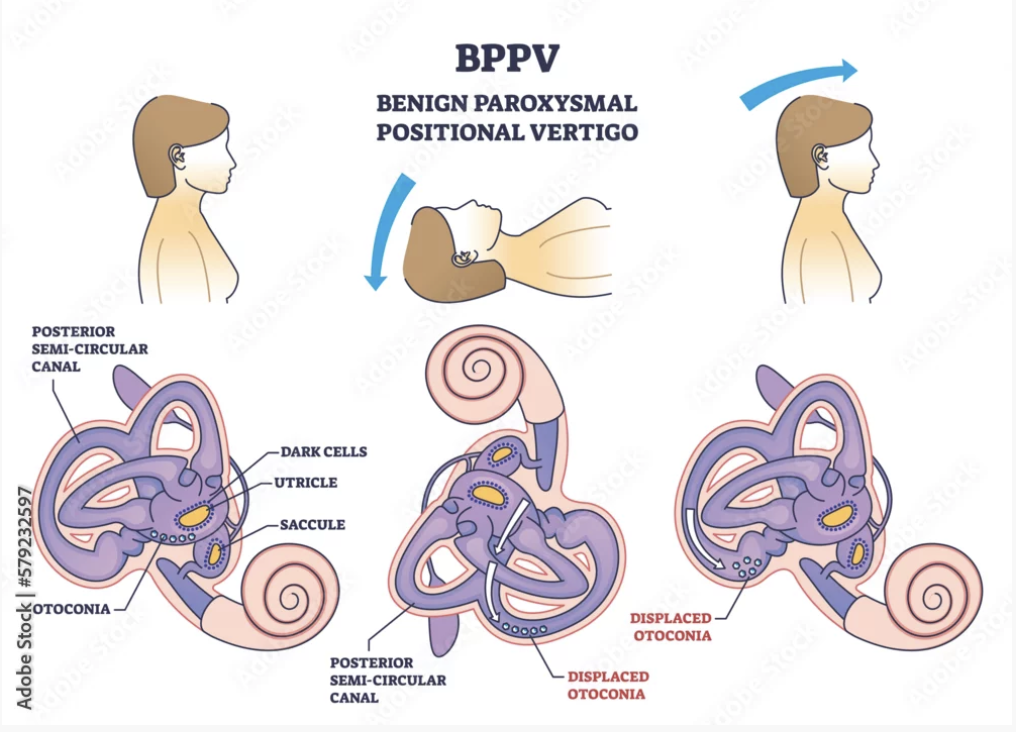 BPPV, vertigo, dizziness treatment