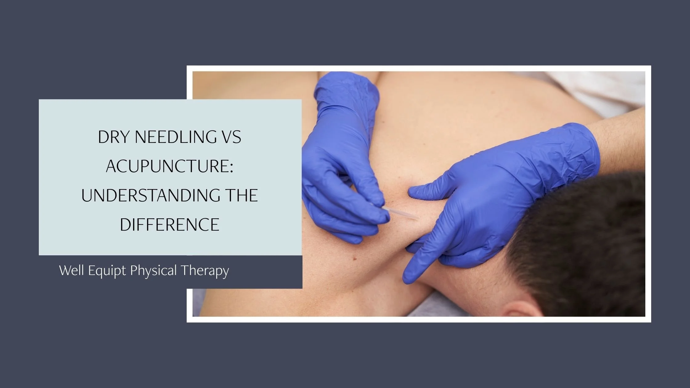 Dry Needling vs. Acupuncture: Understanding the Difference