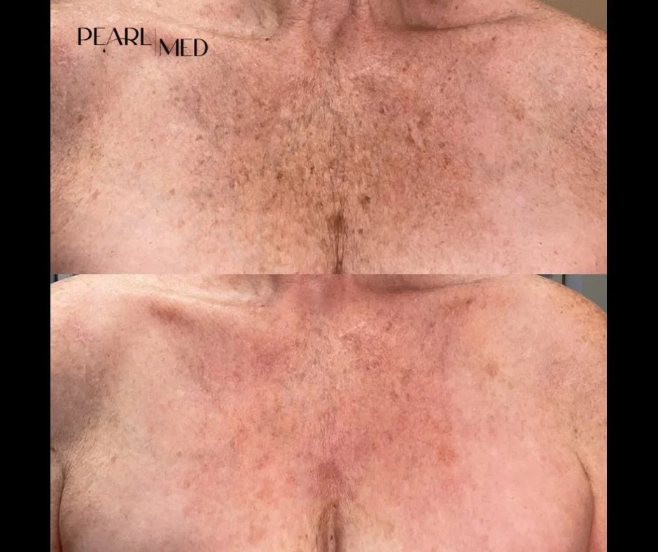 one treatment. 3 weeks apart. say goodbye to sun spots and crepey skin.

#halotribrid #skinrejuvenation #collagenboost #sciton