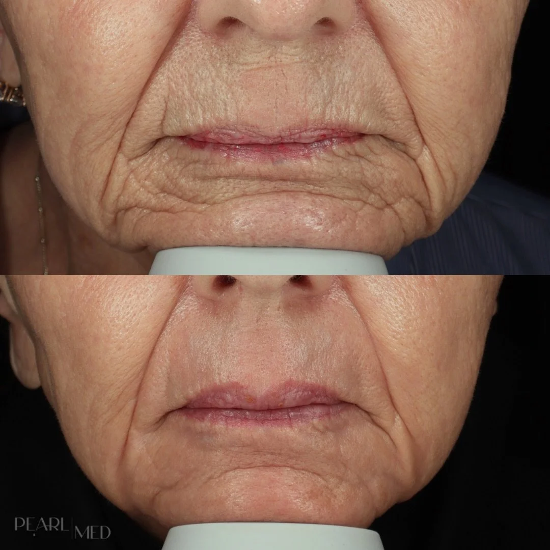 Perioral lines can be some of the most stubborn signs of aging because this area is in constant motion. Over time, volume loss, collagen decline, sun damage, and repetitive movement can lead to deeper creasing around the mouth. 

Contour TRL is one o