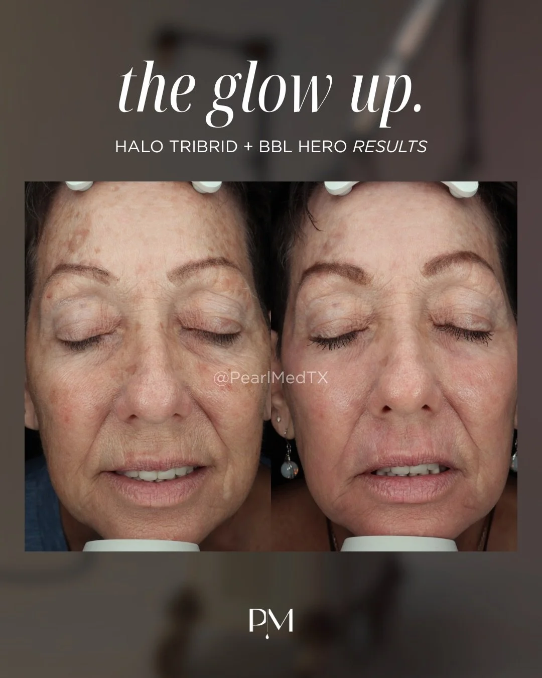 The kind of before &amp; after that speaks for itself.

Halo TRIBRID&trade; takes skin renewal to the next level with a customized approach designed to improve sun damage, uneven tone, texture, fine lines &amp; visible signs of aging.

The goal? Smoo