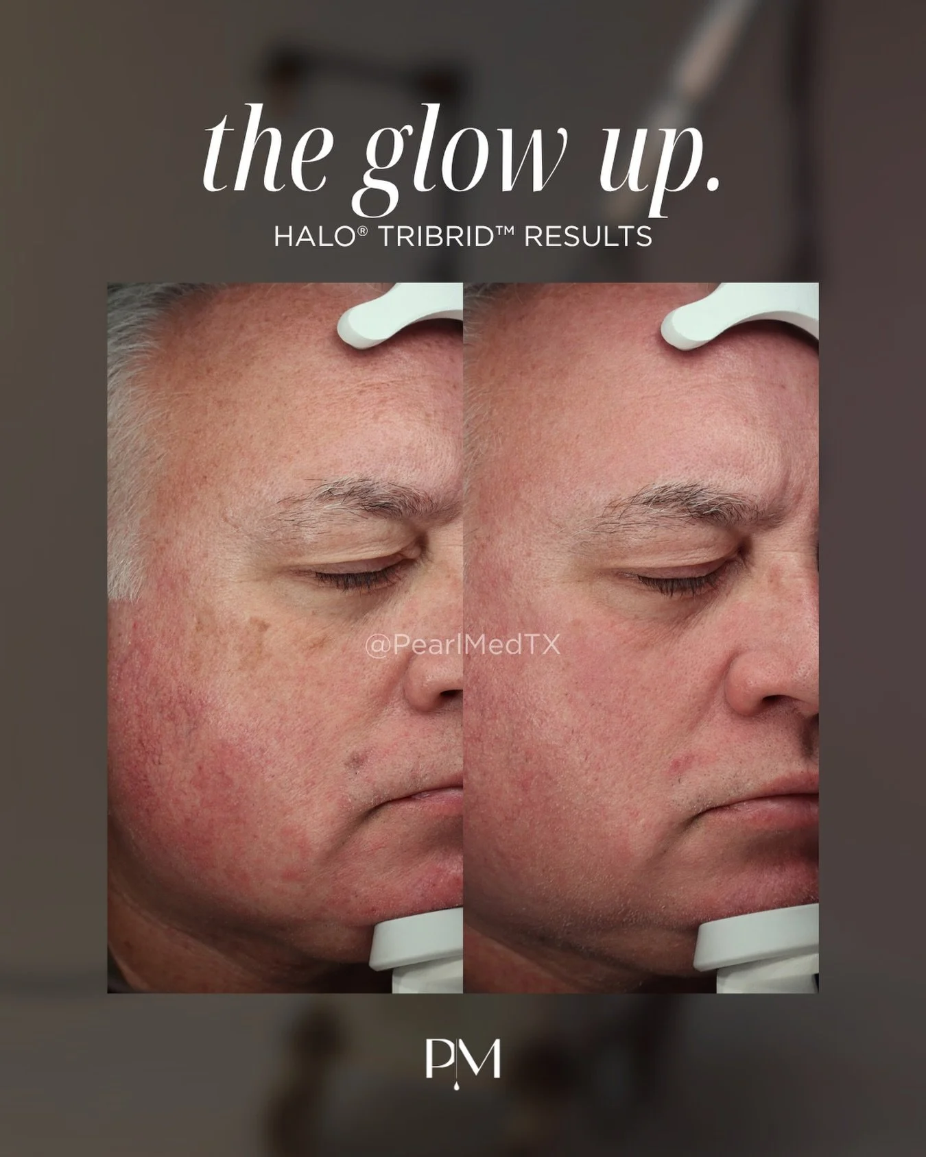 Refined skin isn&rsquo;t just for her.

This Halo TRIBRID&trade; before &amp; after shows what a customized approach to resurfacing can do for men looking to improve sun damage, uneven tone, texture &amp; visible signs of aging&mdash;without changing