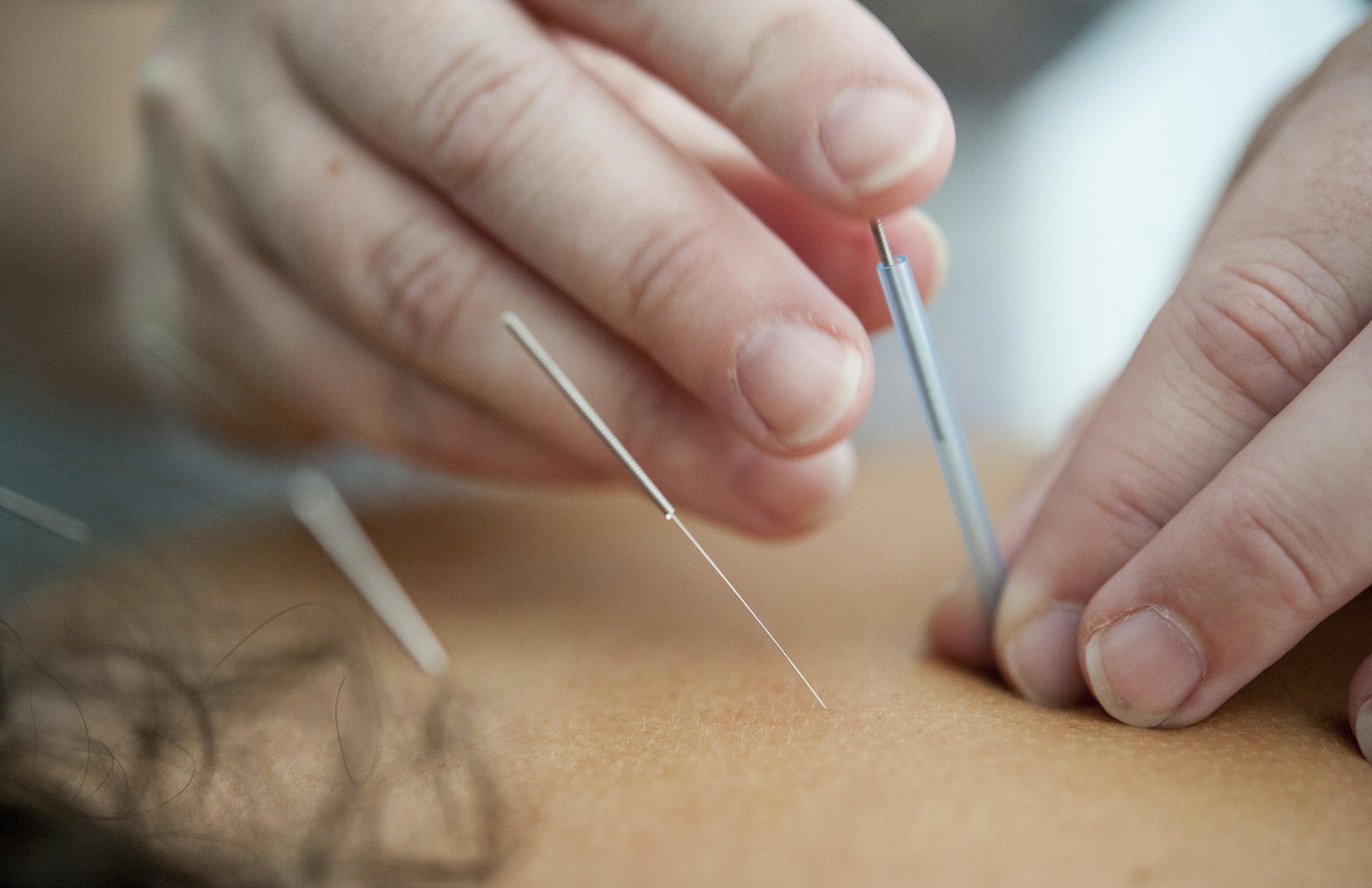What is Traditional Chinese Medicine (TCM) and Acupuncture?