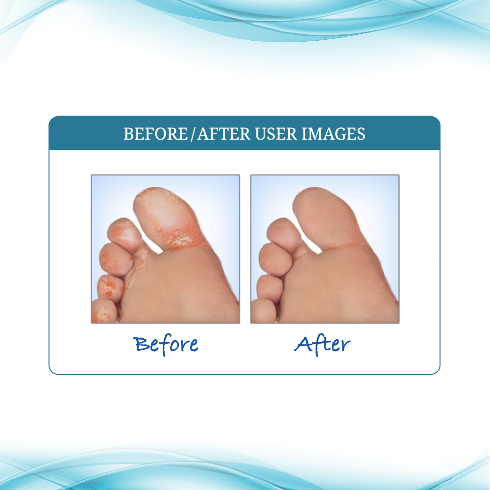 Client testimonial showing an infected “Before” foot and a clean, healthy “After" foot