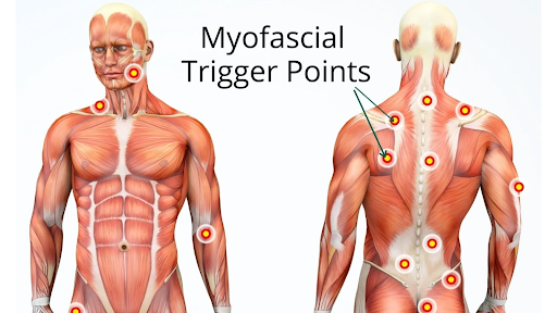 Trigger Points and Muscle Chains in Osteopathy — CLOSED - New River  Osteopathy