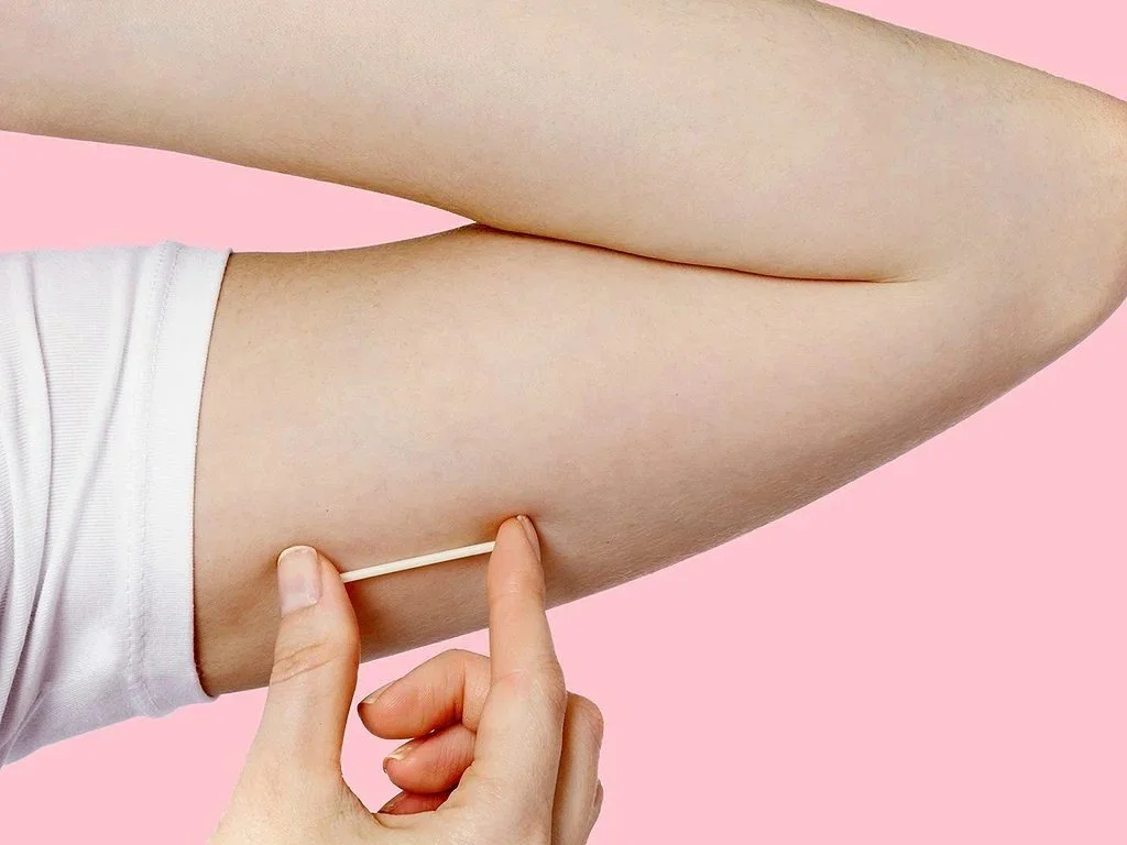 arm implant nexplanon