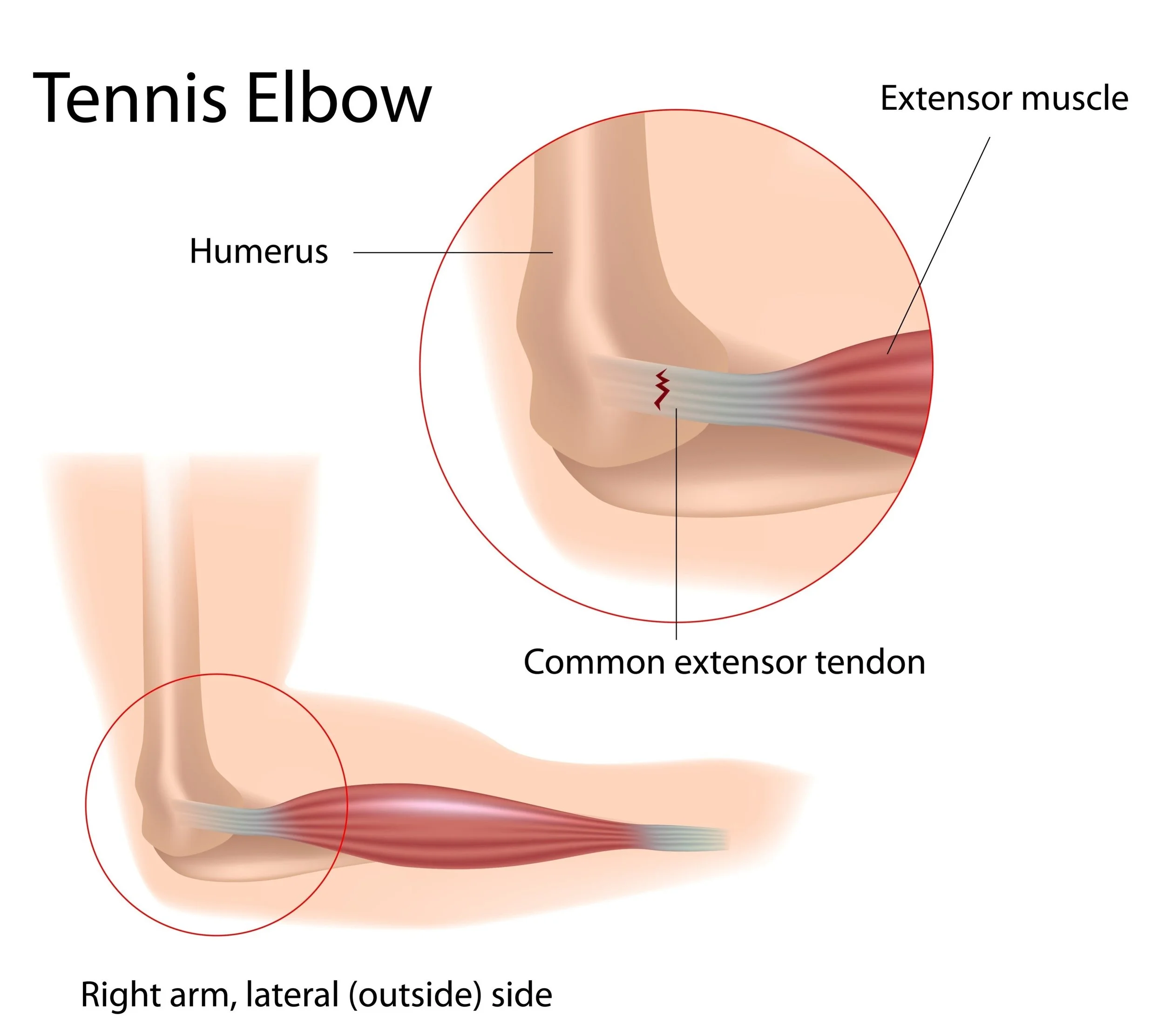 Why Tennis Elbow Hurts When Picking Up a Coffee Cup: A Guide to Forearm Stamina for Conroe Pickleball Players
