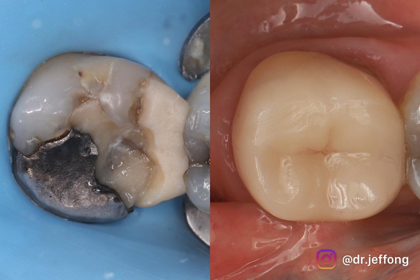 One-year review
Probably one of the most carious tooth I&rsquo;ve restored last year and was getting really close to the pulp. 

Always follow a routine:
1) Accurate diagnosis- symptoms, tests and radiograph 
2) Avoid pulp exposure even if it means l